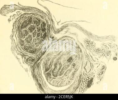 . Beiträge aus der Abteilung für Neurologie und dem Labor für Neuropathologie (Nachdrucke). Rhein Disease of the Radicular Ner/es Journal of Medical Research Vol. XXIII. Platte XIX. •;«i ^/^?fjj. Stockfoto