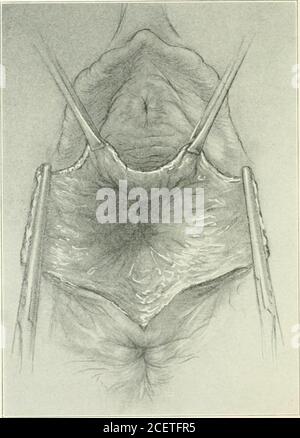 . Amerikanische Zeitschrift für Geburtshilfe und Gynäkologie. Der Gebärmutterhals. Abb. 9 zeigt die Naht, die die freien Kanten des Hernialrings an der Basis der breiten Bänder wiederherstellt. In den schlechten Fällen verwenden wir häufig Leinennähte und in den gemäßigten Fällen chromatische Katzennähte. Zusätzliche Nähte werden nach Bedarf für eine feste Vernähte der Hernie eingesetzt. Diese Nähte sollten so eingefügt werden, dass, wenn tiedthev sind nicht auf unzulässige Spannung. Abb. 10 zeigt die Hernie geschlossen. Die Operation 398 THE AMERICAN JOURNAL OP GEBURTSHILFE UND GYNÄKOLOGIE wird durch die Exzision einer redundanten Schleimhaut und durch subkutane Naht mit Plain abgeschlossen Stockfoto