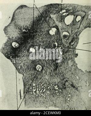 . The Journal of Laryngology and otology. Fio. Y. – erkranktes linkes Ohr. Nein. Lo.i. (Abschnitt mit Eisen-hjematoxylin-Methode gefärbt.) 1. FhcibI Nerven gut behüten. Unten und rechts ist der Nervus decochlear nicht befleckt, und zeigt Degeneration.:i. Mlili.hij ?i. Dilatierte Cochlea iluct der mittleren Spule.I. Tensor tynii)ani.5. Tymi)anic Cavity.C. Carotis-Kanal. 7. Basalspule der Cochlea ersetzt bv Tiew Knochen. 8. .Jugular Inilli. S<. Aijuedukt von cfichlea.. Abb. 7a. – erkranktes linkes Ohr. Nr. 520. 1. Externer Kanal. 2. ADITUS fast durch Verdickung des i Schleimbindegewebes ausgelöscht. 3. Äußere meatus. 4 Stockfoto