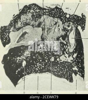 . The Journal of Laryngology and otology. Abb. 7. – normales rechtes Ohr. Nr. 385. 1. Kopf des Malleus. 2. Bod3- des Incus. 3. Zwei Enden des äußeren Kanals. 4. Luft-Zellen hinter Labyrinth.o. Saccus endolymphaticus. 6. Zwei Enden des hinteren Kanals. 7. Juguläre Glühbirne. 8. Trommelfell.. Fio. Y. – erkranktes linkes Ohr. Nein. Lo.i. (Abschnitt mit Eisen-hjematoxylin-Methode gefärbt.) 1. FhcibI Nerven gut behüten. Unten und rechts ist der Nervus decochlear nicht befleckt, und zeigt Degeneration.:i. Mlili.hij ?i. Dilatierte Cochlea iluct der mittleren Spule.I. Tensor tynii)ani.5. Tymi)anic Cavity.C. Carotis-Kanal. 7. Basalspule von Stockfoto