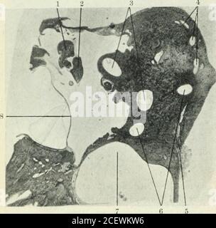 . The Journal of Laryngology and otology. Abb. 6a. – erkranktes linkes Ohr. Nr. 4-45. 1. Extraduralabszess in Verbindung mit Fistel aus der pos- terior i)Art des Vestibuls. 2. Superior Kanal. 3. Externer Kanal. 4. Kopf des Malleus (erodiert)..5. Kurzer Prozess des Malleus. 6. Äußere meatus. 7. Granulares Exsudat in der Trommelfell-Kavität. 8. Jupula-Birne mit faseriger Verdickung (alte Thrombose?) Im Dach. 9. Posteriorer Kanal. 10. Aquädukt der Vorhalle. 632 The Journal of Laryngology, [Dezember, 1913. PLATTE IV. Abb. 7. – normales rechtes Ohr. Nr. 385. 1. Kopf des Malleus. 2. Bod3- des Incus. 3. Zwei Enden des äußeren Kanals. Stockfoto