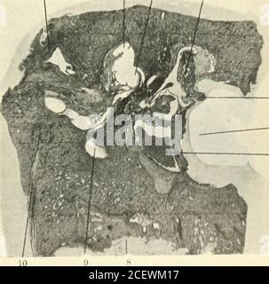 . The Journal of Laryngology and otology. n 10 Abb. 5a. – erkranktes linkes Ohr. Nr. 390. 1. Extraduralabszess in der Region, in der Mitte und hinteren Schädel fossaj verbinden. 2. Ein^Estibule mit neuen faserigen Gewebe gefüllt, ein Fußplatte von Stapes. i. Gesichtsnerv..5. Tensor tym]) ani. 6. Griff von Malleus. 7. Äußere meatus. 8. Vorgebirge. 9. Nische von runden Fenster mit verdickten Schleimhaut gefüllt; beachten Sie neue Knochen in Vestibül A & gt;)Ove runden Fenster. 10. AmpuUäres Ende des hinteren Kanals. 11. Juguläre Glühbirne. 1 2 :< i. Abb. 6a. – erkranktes linkes Ohr. Nr. 4-45. 1. Extraduralabszess in Verbindung mit Fistel aus Pos. Stockfoto