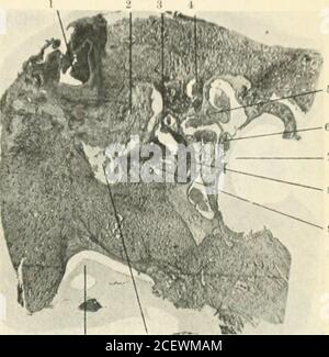 . The Journal of Laryngology and otology. Schwein. 6. – normales rechtes Ohr. Nr. 352. ?*rnal attic.id des Nervus malleus.nal. J Enden des äußeren Kanals. Lerior Kanal. LUains der Fossa suliarcuata im Labyrinth Kern,.^tus endolymphaticus.< Enden des hinteren Kanals.,^llar-Birne, ipotympanic Cavity.Iemal meatus,•npanic Membrane.! IES.iissacs Raum.. n 10 Abb. 5a. – erkranktes linkes Ohr. Nr. 390. 1. Extraduralabszess in der Region, in der Mitte und hinteren Schädel fossaj verbinden. 2. Ein^Estibule mit neuen faserigen Gewebe gefüllt, ein Fußplatte von Stapes. i. Gesichtsnerv..5. Tensor tym]) ani. 6. Griff von Malleus. 7. Extern Stockfoto