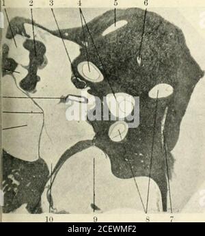 . The Journal of Laryngology and otology. Abb. 5. – normales rechtes Ohr. Nr. 295. Idon des Tensor tympnni. Nervus •ialis. •. PuUa des oberen membranösen Kanals mit Crista. ming- der Crus commune. Jeriorkanal. ns des hinteren Kanals mit Crista quara. Er mit rundem Fenster. Rularbirne. Imontory. emal meatus. Am Trommelkopf befestigtes Ndle of malleus. U. Kopf- und Fußplatte von Stapeln. Schwein. 6. – normales rechtes Ohr. Nr. 352. ?*rnal attic.id des Nervus malleus.nal. J Enden des äußeren Kanals. Lerior Kanal. LUains von Fossa suliarcuata im Labyrinth Kern,.^tus endolymphaticus.< Enden des hinteren Kanals.,^llar Birne,i Stockfoto