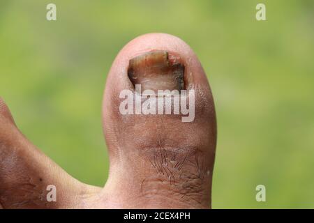 Stellen Sie sich den Nagel, Unfall Nageltrauma, Fußgeschwüre, Onychocryptosis auf grünem Hintergrund Stockfoto