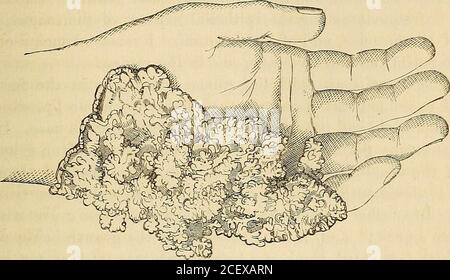 . Vorlesungen über chirurgische Pathologie : gehalten am Royal College of Surgeons of England. Er; Aber sie sind nicht beide gleichmäßig in jedem solchen Teil. Travel oberflächlichen, und besonders travel, travel travel Buchstaben von warty und von Blumenkohlblüten-wie Auswuchsen haben, sind am häufigsten founii auf Schleimoberflächen, especial travel der genitalorgans; travel tiefsitzenden sind in der Zunge als anderswo häufiger; Die an den Extremitäten und im Hodensack haben gewöhnlich einen gut ausgeprägten warzigen Charakter und sind selten tief sitzend. Ich glaube, dass andere Angaben gemacht werden könnten, aber ich bin nicht bereit, das zu sagen Stockfoto