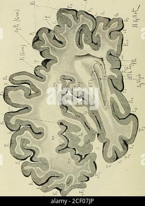 . Anatomie des Centers nerveux. Sceau de Tùrck. – Pu, faisceau uncinatus. - Fus, lobule fusiforme. - H, circonvolution de lhippocampe. - la,insula antérieur. – io, sillon interokzipital. - ip, sillon interpariétal. – ma, sillon marginalantérieur. - mp, sillon marginal postérieur. - ms, siUon marginal supérieur. – JVC, Warteschlange dunoyau Caudé. – 02, O3, deuxième et troisième circonvolutions occipitales. – 0F2, 0F3, partieorbitaire des deuxième et troisième circonvolutions frontales. - OT, sillon collatéral. – P, deuxième sdlon temporal. – vSph,corne sphénoïdale du ventricule latéral. S12 AXATOMIE D Stockfoto