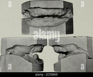 . Der Dental-Kosmos. Zeigt Missverhältnisse der Kiefer bei der Geburt. Wir müssen daran denken, dass die Störung im Knochen existiert, während die Zähne nur helfen, es zu erkennen. Als Beweis für zwei waren Neugeborene und onesix Wochen alt. Natürlich, da es unmöglich war, Modelle oder Evenphotos in den gewünschten Positionen zu erhalten, musste ich auf eine schriftliche Aufzeichnung von ihnen zurückgreifen.der obere alveoläre Prozess war in ad-vance des unteren, Und die Ausdrucküber den Mund ähnelte sehr viel dem, was so eng mit einem Kasei der Klasse II, Abteilung 2, im Erwachsenen verwandt ist. Eines dieser Säuglinge ist jetzt zwei Jahre Stockfoto