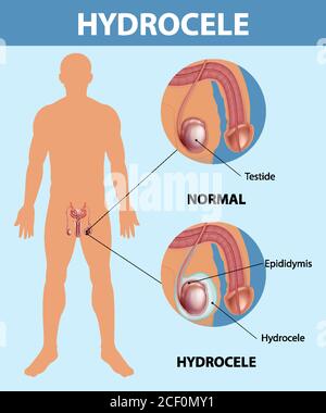 Medizinisches Poster zeigt verschiedene männliche normale Hoden und Hydrozele Abbildung Stock Vektor