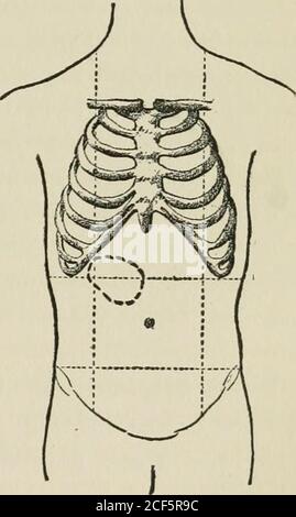 . Vorträge über die Diagnose von Bauchtumoren, an die Post-Graduate-Klasse der Johns Hopkins Universität, 1893. Rned in diesem Land im vergangenen Jahr. Vor vier Monaten hatte er einen Schmerzanfall im Unterleib mit Erbrechen, und die Symptome haben seitdem bestanden.das Erbrechen ist chieiiy nach der Nahrungsaufnahme, und die Schmerzen sind auch die meisten se-vere zu dieser Zeit. Er hat nie vom-ited Blut. Eingeweide wurden verstopft. Er hat an Gewicht verloren, hedhink, so viel wie vierzehn Pfund.Er ist kurz des Atems bei Anstrengung, und wenn er ungefähr für anylength der Zeit die Füße und anklesswell geht. Aktuelle Bedingung. Stockfoto