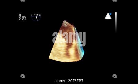 3D-Bild des Herzens während der transösophagealen Ultraschall des Herzens. Stockfoto