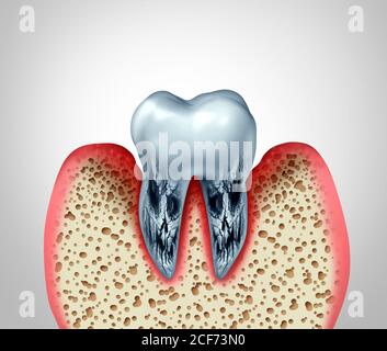 Toter Zahn und sterbende Zähne Stomatologie Zahnerkrankungen und schlechte Mundhygiene Gesundheitsproblem aufgrund von Bakterieninfektion und Hohlraum oder Hohlräume. Stockfoto