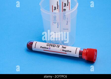 Von oben Nahaufnahme der Reagenzgläser mit Blutproben in Kunststoffbecher für Coronavirus-Diagnosetest mit positiver Markierung platziert Auf blauem Hintergrund Stockfoto