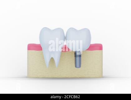 Molar Tooth and Tooth Implantat im Zahnfleisch, Zahnimplantation, Kunstzahn, 3d Render Stockfoto