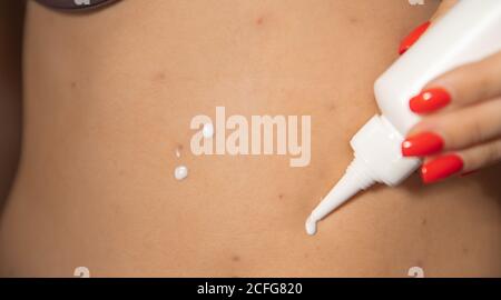 Close up Frau Anwendung Creme auf Haut krank mit Windpocken Stockfoto