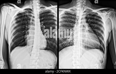 Röntgenbild der menschlichen Brust, links und rechts. Stockfoto