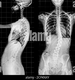 Röntgenaufnahme der Wirbelsäule und des Beckens des menschlichen Skeletts. Stockfoto