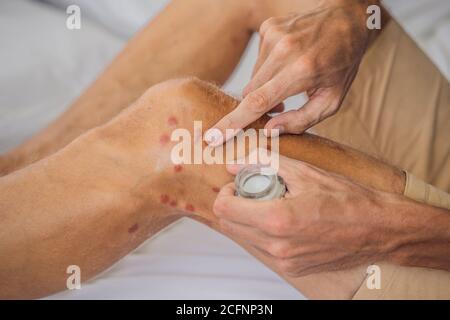 Beine mit vielen roten Flecken und Narben von Insektenstichen. Moskitonallergie. Sandfliegenbisse Stockfoto