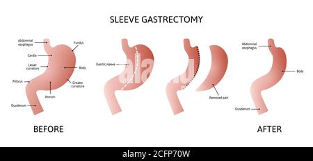 Vertical Sleeve Gastrektomie. Menschliche Bauchanatomie isoliert auf weißem Hintergrund. Abnahme des Bauchvolumens. vektor-Illustration mit Linien markiert. Stock Vektor