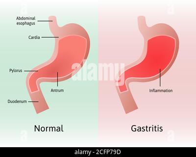 Gastritis, eine Entzündung, Reizung oder Erosion der Magenschleimhaut. Medizinische Vektordarstellung mit Linien gekennzeichnet. Alle Teile des Magens Stock Vektor