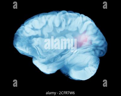 Gehirn zerebrale Aneurysmen verursacht hämorrhagischen Schlaganfall oder Lähmung Stockfoto
