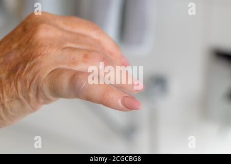 Gebrochener oder gebrochener Finger einer älteren Frau in ihr 80s in Nahaufnahme zeigt die akute Schwellung der Ziffer in einem medizinischen und medizinischen Konzept Stockfoto