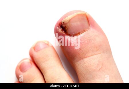 Infizierte eingewachsene Zehennagel auf einem Teenager-männlichen großen Zeh vor einem weißen Hintergrund. Stockfoto