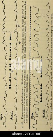 . Klinische Störungen des Herzschlags: Ein Handbuch für Praktiker und Studenten. Mit allen klassischen Anzeichen von Herzinsuffizienz. Viele der mikroskopischen Läsionen sind als Folge von Infektionen, die Herz-Failurerather als Fibrillation. Ähnliche Läsionen gefunden wherefibrillation hat nie aufgetreten; und Herzen, die shownthis Störung haben, können nicht die beschriebenen Läsionen präsentieren. Die Erkennung von Herzkammerflimmern. Aurikuläres Fibrillation läßt in einem klinischen Fall zu twoseries der Phänomene steigen; das eine, das nach der virtualparalysis des auricle abhängt; das andere de Stockfoto