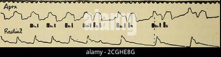 . Klinische Störungen des Herzschlags : ein Handbuch für Praktiker und Studenten . o (ft) Halbierung der Frequenz des arteriellen Pulses, und Herzgeräusche in Gruppen von drei (Abb. 24 g und 28). Die Differenzierung von vorzeitigem aurikulären und ventrikularem Herzschlag ist ohne instrumentelle Untersuchung nicht immer möglich. Wo ein gelegentlicher vorzeitiger Schlag auftritt, sind die Indica-tionen seines ventrikulären Ursprungs wie folgt : (A) Es gibt keine Störung des grundlegenden Herzrhythmus. Der Prämienzwulstschlag * kann auch für Gruppen von drei arteriellen Herzschlägen verantwortlich sein, wenn sie jeden vierten Rhythmus ersetzen Stockfoto