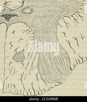 . Internationale Aufzeichnungen der Medizin . e wahre Fälle von Heterotopie der Grauen Substanz des Rückenmarks. Picks (5) Fälle, Nr. 1,1878. – die Schnur wurde von einem gut ausgebildeten Mann genommen, der mit fortschreitender Muskelatrophie starb.im Zuge der mikroskopischen Untersuchung des Schnur-Aminutklumpens von grauer Substanz wurde nur ein Millimeter im Diame-ter in den hinteren weißen Säulen des Lendenbereichs verlegt gefunden. (Siehe Abb. 1, Nachzeichnung des Originalschildes.) Die Masse war so klein, daß nur wenige Sektionsstücke davon geschnitten werden konnten, und als die Sektionen durch sie gingen, wurde der verlegte Klumpen kleiner und schließlich Stockfoto