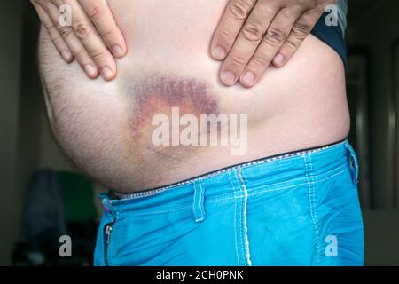 Blutergüsse, Hämatom am menschlichen Körper. Große Blutergüsse, Blutergüsse auf dem Bauch eines Mannes nach einer Verletzung. Stockfoto