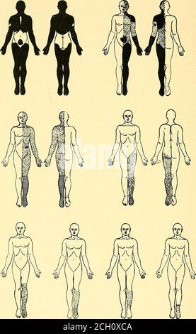. Eisenbahn und andere Unfälle im Zusammenhang mit Verletzungen und Erkrankungen des Nervensystems : ein Buch für den Einsatz vor Gericht . tatsächliche Lähmung existierte, und die elektrischen Re-Aktionen der Muskeln waren gut, obwohl es eine leichte Dimmung in Reaktion auf den induzierten Strom. Mehrere Monate lang, bevor ich sie sah, hatte sie sich auf dem Rücken gelegen, mit gezogenen Füßen und gebeugten Knien, und es war nur schwer, dass die unteren Extremitäten vollständig ausgestreckt werden konnten. Im Glauben an den Fall einer Hysterie, isolierte ich sie sofort und sie wurde systemisch von mentalen Therapeutika und richtig diszipliniert behandelt Stockfoto