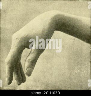 . Eisenbahn und andere Unfälle im Zusammenhang mit Verletzungen und Erkrankungen des Nervensystems : ein Buch für den Einsatz vor Gericht . Aintained, die Bildung einer harten Projektion entspricht den Synovialsäcke durch die der extensor Tendonspass, oder eine Hypertrophie der Karpaltknochen selbst (Abb. L 30, S. Manchmal sind wir aufgerufen, zwischen traumatischer Lähmung und der Form aufgrund von Bleivergiftung zu unterscheiden, und es treten auch Fälle auf, in denen es sich um einfache Drucklähmungen aufgrund der Verwendung von Akrutch oder nach einer Form der Kompression der Nervenkrankheit durch einen harten Körper handelt, Oder wie tritt auf, wenn ein p Stockfoto