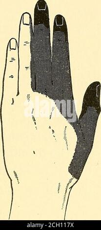 . Eisenbahnunfälle und andere Unfälle im Zusammenhang mit Verletzungen und Erkrankungen des Nervensystems : Ein Buch für den Hofgebrauch . Tage war der Daumenball taub, aber über der Wunde für einen Zoll oder so gab es exquisiteHyperästhesie, so dass die geringste Berührung verursachte große Qual.für zwei oder drei Wochen nach Erhalt der Verletzung waren die entireleft Arm und Schulter hyperästhetisch; Aber es gab keine tiefe Zärtlichkeit über den Nervenstämmen, und diese ließ bald nach. Es erschien wieder in der linken Schulter um den 23. Dezember. Über Janu-ary 6. Ein Zucken des linken Arms und der Hand wurde zuerst bemerkt, und wurde mor Stockfoto