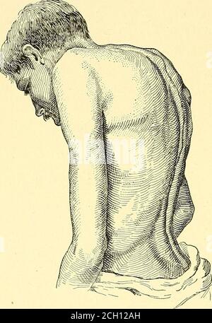 . Eisenbahn und andere Unfälle im Zusammenhang mit Verletzungen und Erkrankungen des Nervensystems : ein Buch für den Gerichtsgebrauch . Lammation der Bandscheiben weiter unten, mit Kyphose, und möglicherweise mit der Bildung von ischial Abszesse. Unvollständige Wirbelfraktur mit Querschnittsbildung des Rückenmarks möglicherweise unlösbar und gefährliche Folgeerscheinungen von Unfall, insidiousin Entwicklung undlangsam im Gange. Es ist oft dififtcult, am Anfang wegen des Abwesenheitseiner äußeren Deformität, und wegen des Wiederscheins einer Vielzahl von anderen Affektionen, und aus dem Grund, dass extra-durale Blutung, Stockfoto