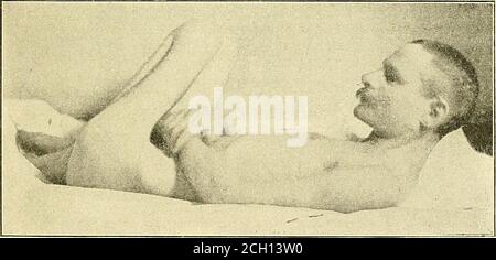 . Eisenbahn und andere Unfälle im Zusammenhang mit Verletzungen und Erkrankungen des Nervensystems : ein Buch für den Einsatz vor Gericht . Posed auf macht eine wahnsinnige Erklärung, die vollkommen zufriedenstellend ist, wenn nicht zu others.He ständig plant, kein Schema zu extravagant für Feige. 19. – Facies paretischer Demenz. TRAUMATISCHER WAHNSINN. I6i ihn zu adoptieren. Manchmal ist er gewalttätig, vor allem wenn er mit in-terfered, und als das Ergebnis seiner Wahnvorstellungen kann sogar destruktiv werden, aber im Gegensatz zu den paranoiac, er kann abgelenkt oder geführt, oder eine neue Idee vorgeschlagen und Readilyadoptiert werden. Halluzination und Inkohärenz, Stockfoto