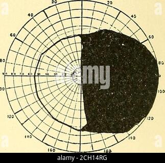 . Eisenbahn und andere Unfälle im Zusammenhang mit Verletzungen und Erkrankungen des Nervensystems : ein Buch für den Einsatz vor Gericht . Abb. ist. - rechts Homon^-mous hemianopsia. (Purves-Stewart.) Flecken, die mit schillernden Farben gesäumt sind. Sie dauern eine Zeit lang an und verschwinden in Richtung der Peripherie des Gesichtsfeldes. Der Okulomotoriis oder der Nervus t/m^d betrifft die Reflexbewegungen der Iris, die innere Vation des Levator palpebrarum sowie alle Muskulatur des Augapfels, mit Ausnahme des oberen schrägen, der durch den Patheticus oder den vierten Nerv und den äußeren Rectus betreut wird, Stockfoto