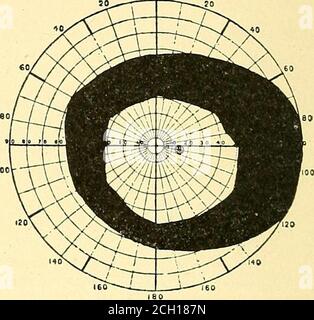 . Eisenbahn und andere Unfälle im Zusammenhang mit Verletzungen und Erkrankungen des Nervensystems : ein Buch für den Einsatz vor Gericht .. Abb. 9. – gekreuzte (funktionale) Amblyopie. (Purves-Stewart.) Hauptleitung; wieder ist die letzte Farbe, die bleibt, blau. Whennone ist zu unterscheiden, die Patienten sehen alles Graue. Der Verlust ist gewöhnlich konzentrisch, und es ist mit einem geeigneten Gerät möglich, die verschiedenen Begrenzungslinien und den Abstand, in dem die Farben verloren gehen, deutlich zu markieren. Der Kammgarnum ist ebenfalls erhältlich. Monokulare Probleme sind signifikant und unilateral, andhemianopsia oder Diplopie, die keine schweren c Stockfoto