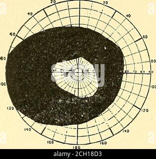 . Eisenbahn und andere Unfälle im Zusammenhang mit Verletzungen und Erkrankungen des Nervensystems : ein Buch für den Einsatz vor Gericht . f dieser Verlust zu zeigen, dass in der hypnotischen Zustand der Patient mit hysterischen Einschränkung der Tields of Visionmay gemacht werden können, um Objekte innerhalb der blinden Grenze zu sehen. Sidis und White haben zugegeben, dass ein helfloses Subjekt hysterischer Lähmung, wenn hypnotisiert, Handlungen durchführen konnte, die unmöglich waren, wenn er bei vollem Bewusstsein war. Wenn ein pairof Schere wete in seiner gelähmten und Narkosehand er sie benutzen konnte; und er würde auch einen Bleistift verwenden. Natürlich ist in incap nichts dergleichen möglich Stockfoto