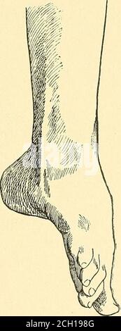 . Eisenbahn und andere Unfälle im Zusammenhang mit Verletzungen und Erkrankungen des Nervensystems : ein Buch für den Einsatz vor Gericht . Abb. 5. – hysterische Kontraktur des Fußes. (Richet-Preston.) kein echter Main-en-griffe, wie gehört zu Verletzungen oder Krankheit des Ulnarnervs oder progressive Muskelatrophie. Wie die Lähmung sind solche Kontrakturen in der Regel mit den sensorischen Symptomen der Hysterie assoziiert. 54. J^A/LWAV UND ANDERE UNFÄLLE. Wenn das Bein und der ^-Ruß zusammengelegt sind, finden wir eine extreme Ausdehnung, die sich vom Abdunst ausdehnt. Das Aussehen des Fußes ist ganz anders als die Zugehörigkeit zu jedem Stockfoto