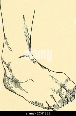 . Eisenbahn und andere Unfälle im Zusammenhang mit Verletzungen und Erkrankungen des Nervensystems : ein Buch für den Hofgebrauch . das Handgelenk, mit Biegung der ersten Phalanges auf den Mittelhandknochen. Die andere, aber ein leichter Grad der Beugung. Das Aussehen der Hand ist auffällig, die Finger sind gleichmäßig gedrängt und so zusammengedrängt, dass sich eine Art Kegel bildet, dessen Spitze der Extremität des letzten ACCiniiNT ABOUJJA entspricht. 53 Phalanx. Der Daumen ist adckictccl und stark gegen den Zeigefinger geschleppt, und die ganze Hand ist ziemlich stark gebeugt. Manchmal gibt es einen größeren Grad Stockfoto
