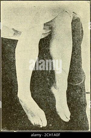 . Eisenbahn und andere Unfälle im Zusammenhang mit Verletzungen und Erkrankungen des Nervensystems : ein Buch für den Gerichtsgebrauch . Neous Anes-thesia, die das Organ des besonderen Sinnes, sowie assome der tieferen Teile des Körpers betrifft; Hyperesthesia und Dyssesthesia, neben bestimmten bizarren Störungen der Atmung, Verdauung und Miktion. Motorische Störungen. - Amyosthenie oder muscularweakness geht häufig komplette Lähmung voraus, oder die lattermay plötzlich auftreten, whichis die Regel. Es wird oft durch einen unerwarteten Verlust der Macht, die, wie immer, ist vorübergehend, und kann dazu führen, dass der Patient plötzlich auf die gr. fallen Stockfoto