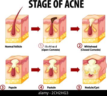 Stadien der Haut Akne Anatomie Illustration Stock Vektor