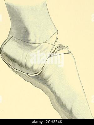 . Textbuch der operativen Chirurgie . er, J. Bell hat 1885 eine innere Fersenlappe aufgeschlagen.nach der Teilung der Haut werden die starken Bänder des äußeren Seitenbandes, der Peronealtendonen und der Extensorsehnen auf Höhe der Retractcd-Haut durchgeschnitten.das Sprunggelenk wird geöffnet, Und der innere Aspkt des os calcis wird von der inneren Klappe aus abovedownwards seziert, indem man Closc bis zum Knochen hält. Die Malleoli sind schräg geteilt, aber die knorpelige Abdeckung der Tibia bleibt erhalten. 348 OPERATIVE CHIRURGIE Poncet hat gezeigt, dass ein sehr gocl Stumpf auch durch obtaiiied werden kann Stockfoto