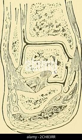 . Textbuch der operativen Chirurgie . Abb. 217. – Gnyon.s Wave-cnt IBR disailioulatiou am thu Knöchel. Abb. 218. – koronale Sektion tlirougli das Sprunggelenk (Lienle). Roux und Verneuil. Nach Tauber hat J. Bell 1885 eine innere Fersenlappe eingeschlagen.nach der Teilung der Haut werden die starken Bänder des äußeren Seitenbandes, der Peronealtendonen und der Extensorsehnen auf Höhe der Retractcd-Haut durchgeschnitten.das Knöchelgelenk wird geöffnet, Und der innere Aspkt des os calcis wird von der inneren Klappe aus abovedownwards seziert, indem man Closc bis zum Knochen hält. Die Malleoli wurden geteilter und geteilter Stockfoto