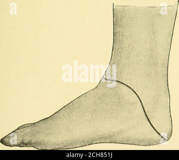 . Textbuch der operativen Chirurgie . Abb. 216. – Disaiticulatioii at tlie aiils-lo-Joint by ineaiis of an internal Aap (Syniesampntation modified). Nachteil der niethod ist, dass nach dem Anbringen der Fersenklappe in Position noch eine Kavität zwischen ihr und den Knochen existiert. Der Schläger iucision ist vorzuziehen, die Klappe, die von der Innenseite des Fußes genommen wird, beginnend an der Spitze des äußeren Malleolus (Abb. 2IG). Tliis methodresembles meisten der internen Klappe von Faraboäuf empfohlen, avnil die Methoden der. Stockfoto