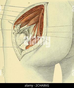 . Text-Buch der operativen Chirurgie . entlang mit dem Periost über den Knochen. Alle äußeren Rotatoren, zusammen mit dem Periost (oder einer oberflächlichen Knochenschicht), werden dann nach hinten zurückgezogen, beginnend vor der Sehne des Obturator internus, der beiden gemelli, und der Obturator ARDROSSOMIE, OSTEOTOMIE, UND RESEKTION 505 externus. Im TMS-Weg Tlie Periosteum, das die innere Oberfläche des Tlie trochanter bedeckt, werden zusammen mit den Stmkturen, die an seiner hinteren Oberfläche befestigt sind, in ihrer Kontinuität reflektiert (Abb. L 169, S. Durch diese Methode die Muskeln, die durch den oberen giutealen Nerv, nämlich Stockfoto