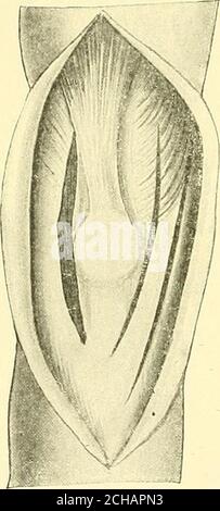 . Textbuch der operativen Chirurgie . 19. Ardrossomie für die gewohnheitsmäßige Dislokation der Patella (kongenital). Thepatella niay nach außen entweder aus angeborenen Gründen oder als Folge von Atrauma verdrängt werden. Die Verschiebung wiederholt sich sehr leicht auf dem Winkel, der auf der Außenseite des Knies durch die TilDia und Oberschenkel gebildet wird, was den Quadrizeps eine apreponderating Zug nach außen gibt. Das Aufbringen der Kapsel auf der Innenseite der Patella mit einer Wägelnaht (mauernaht) hat zufriedenstellende Ergebnisse erzielt, Avhile gleichzeitig wird der Aponeu-rosis des Vastus internus längs gespalten und Stockfoto