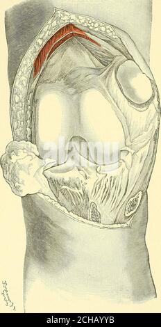 . Textbuch der operativen Chirurgie . ^3«^, ■&gt;^&gt;V Abb. 159. – Artlirotomie des Knies. Das Gelenk ist geöffnet worden und die Patella, mit dem quadricepstendon und ligamentum patellse nach innen gezogen worden; auch travel Tuberosität der Tibia, travel durch hasbeen gemeißelt worden ist, und wird gesehen, travel seinen normalen conneetion mit dem patellaren ligamentabove und dem Periosteum unten beibehält. 296 OPERATIONELLE OPERATION die Patella sollte nun zur Innenseite hin ausgereotst werden (Abb. 159), und durch Ablösen der Kapsel von der Tibia innen und außen, kann das Bein mehr und mehr gebogen werden, bis es schließlich vollständig gebeugt ist. Stockfoto