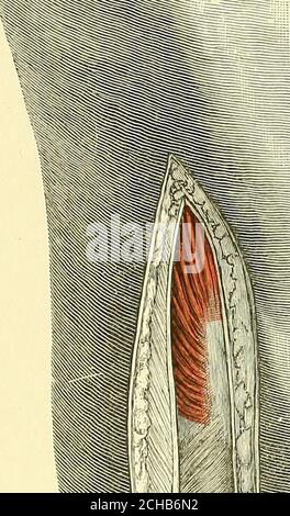 . Textbuch der operativen Chirurgie . 157.---Einschnitt für die Artlirotomie des Knies. Welche Richtung auch immer notwendig erscheint, und unsere Exzisionsmethode entspricht der Methode der Ardrotomie. Langenbeck hat einen ähnlichen Einschnitt verwendet, aber er macht ihn geschwungener und legt ihn auf die Innenseite des Gelenks. Es ist jedoch besser, den Einschnitt auf der Außenseite zu platzieren, denn sollte das Knie nachgeben, ist es fast immer in Richtung Genu valgum. Es ist daher wichtig, dass die Resistenz des Gewebes auf der inneren Seite nicht durch die Teilung verringert werden sollte, und aus diesem Grund Stockfoto